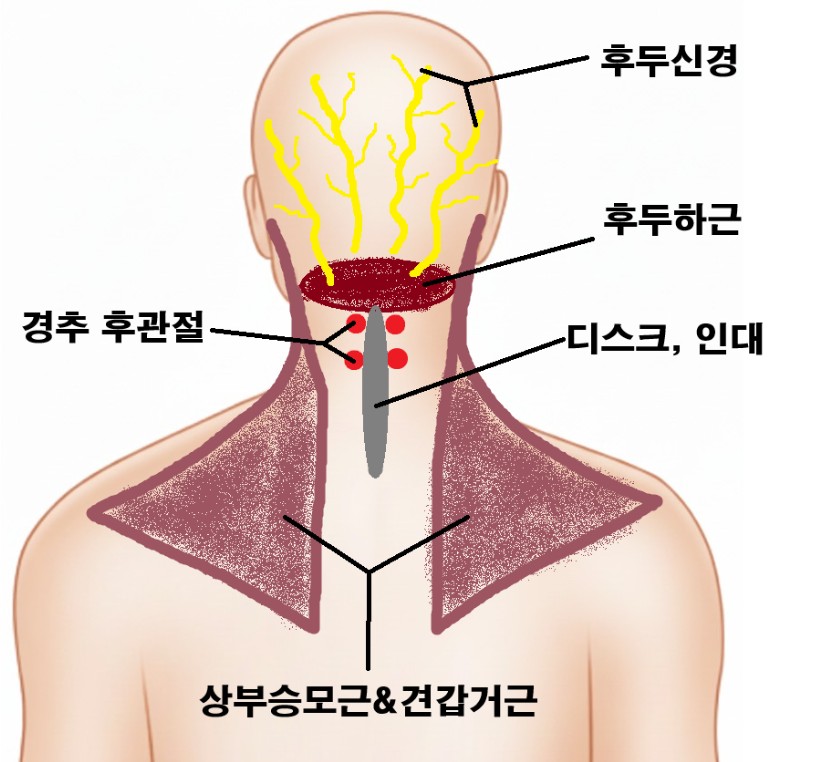 경추성두통의 원인을 나타내는 이미지