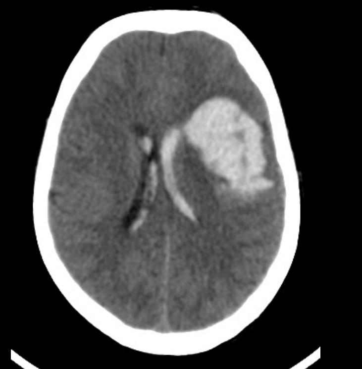 ICH의 brain CT 이미지