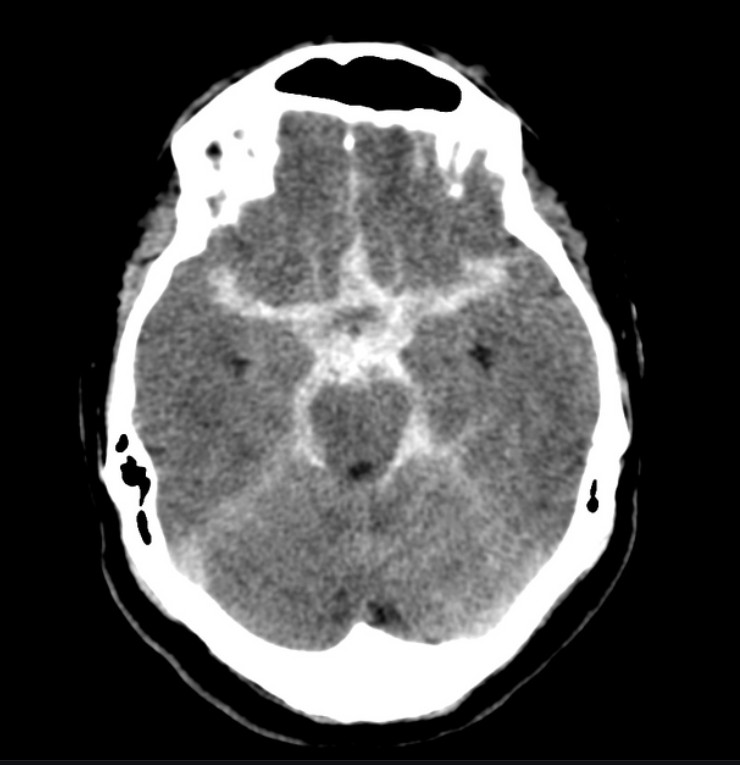 SAH의 brain CT 이미지