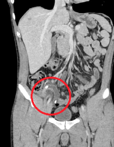 맹장염 CT이미지