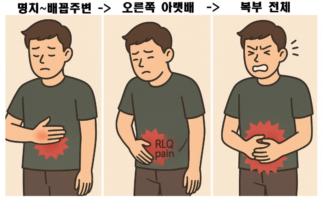 맹장염 통증변화 이미지