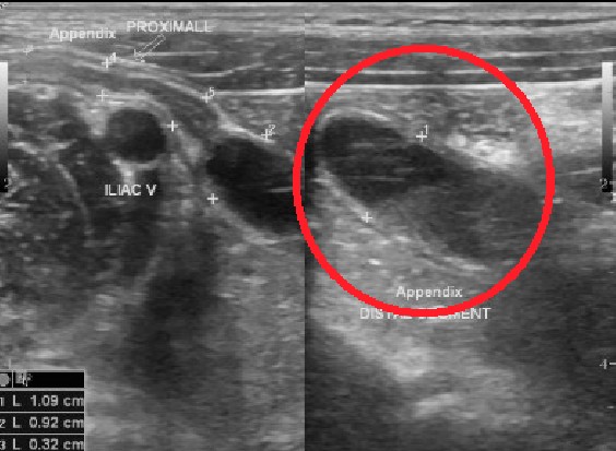 맹장염 초음파이미지