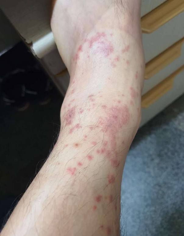접촉성 두드러기를 보여주는 풀독사진