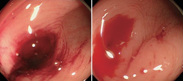 게실출혈 내시경소견