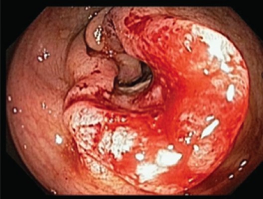 대장암 출혈 내시경소견