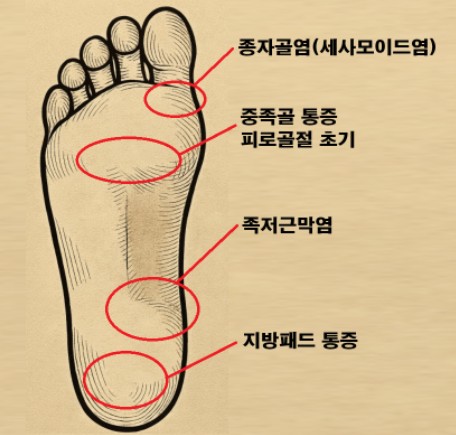 발바닥통증 위치 이미지