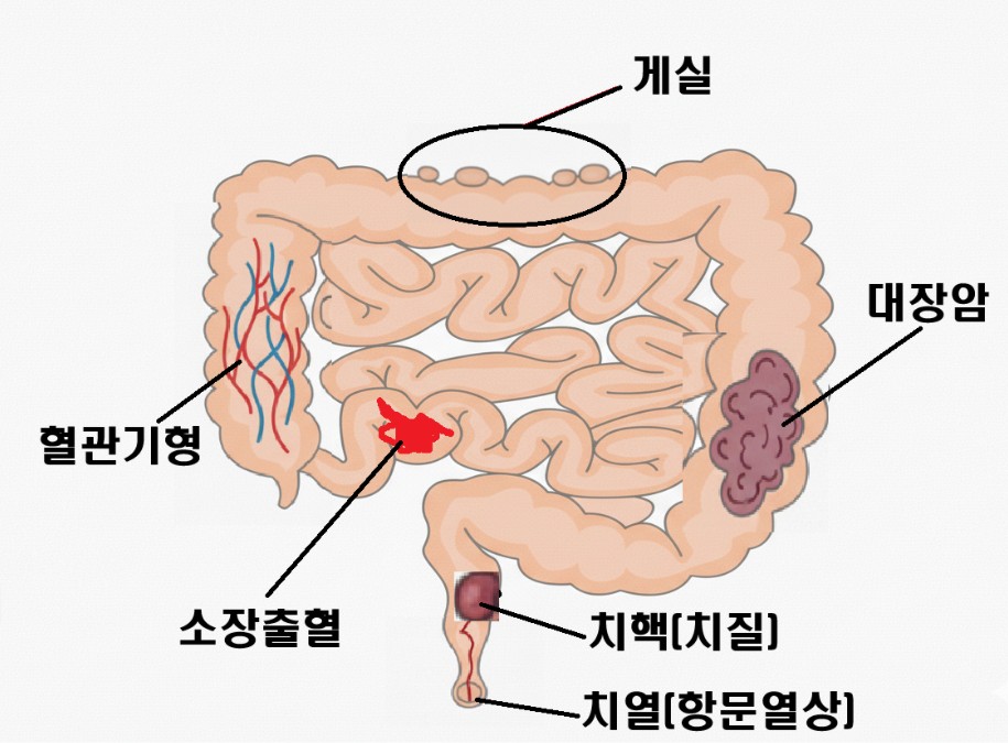 혈변의 원인병변을 보여주는 이미지