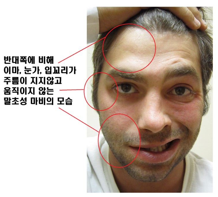 안면마비의 전형적 증상을 보여주는 이미지