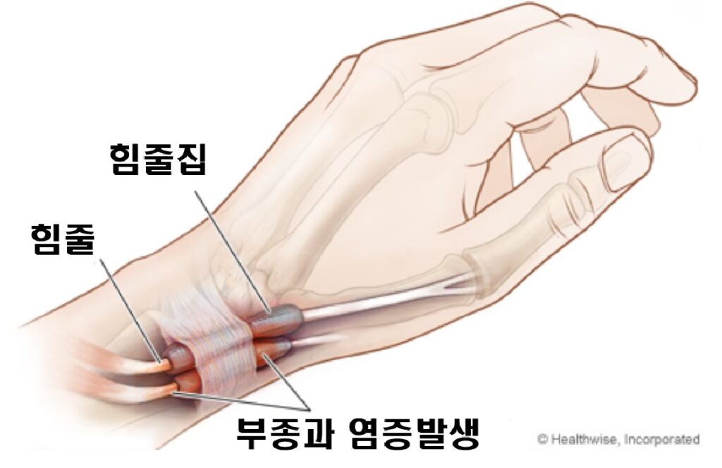 드퀘르뱅병의 해부학을 보여준 이미지