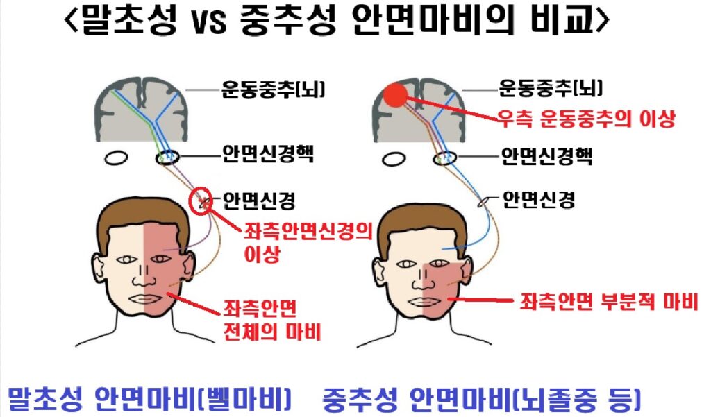 말초성 vs 중추성 안면마비의 원리와 증상 비교하기