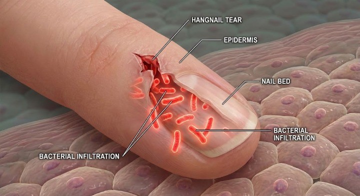 손가락 손톱아래에 염증이 침투하는 것을 직관적으로 보여주는 이미지