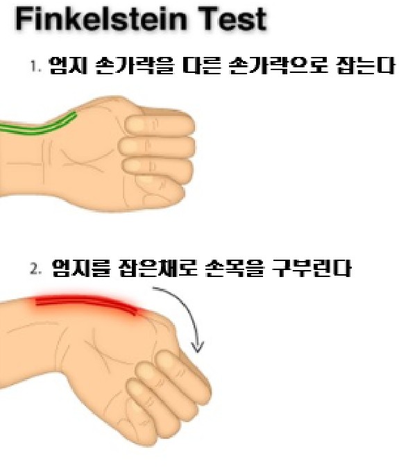드퀘르뱅병을 확인하는 테스트