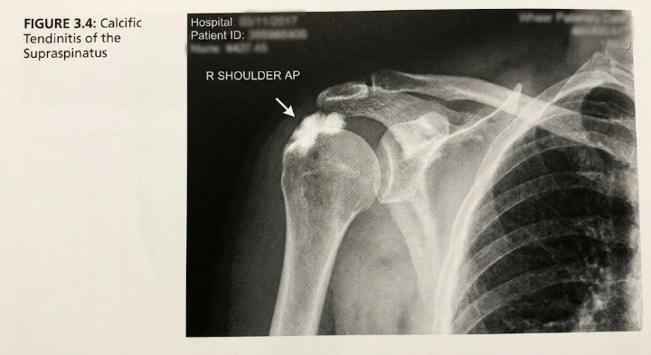 석회성건염의 xray이미지